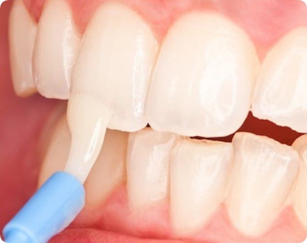 Реминерализация и фторирование зубов 