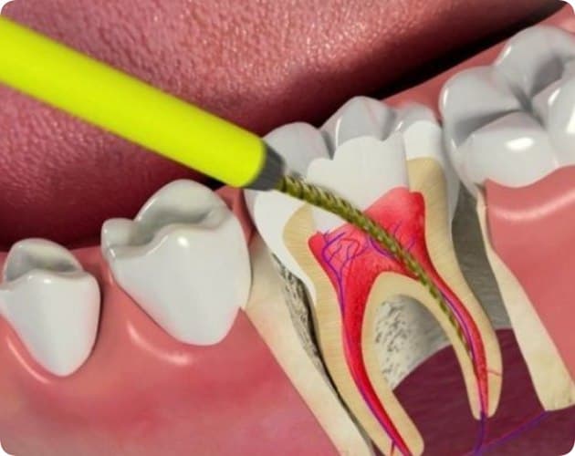 Лечение периодонтита зуба 